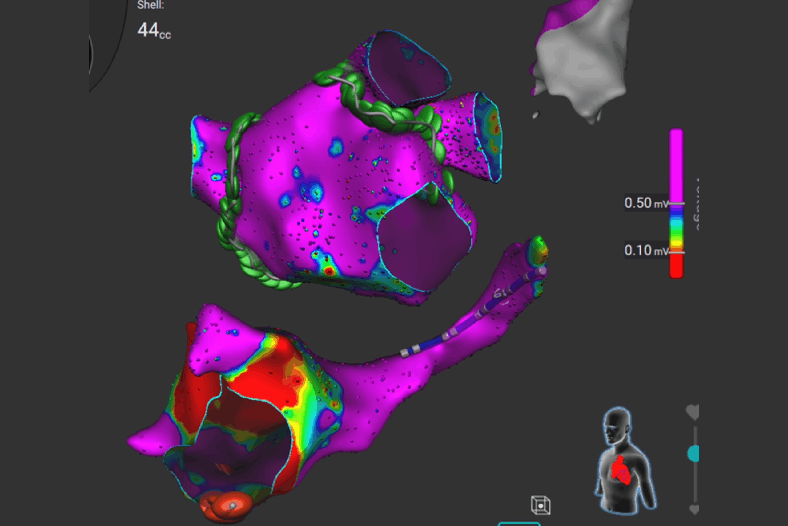Prism-2 Software for Medtronic Affera System. Beacon Hospital is a global leader in this Cath Lab technology. 